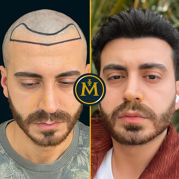 Hair Transplant Before and after