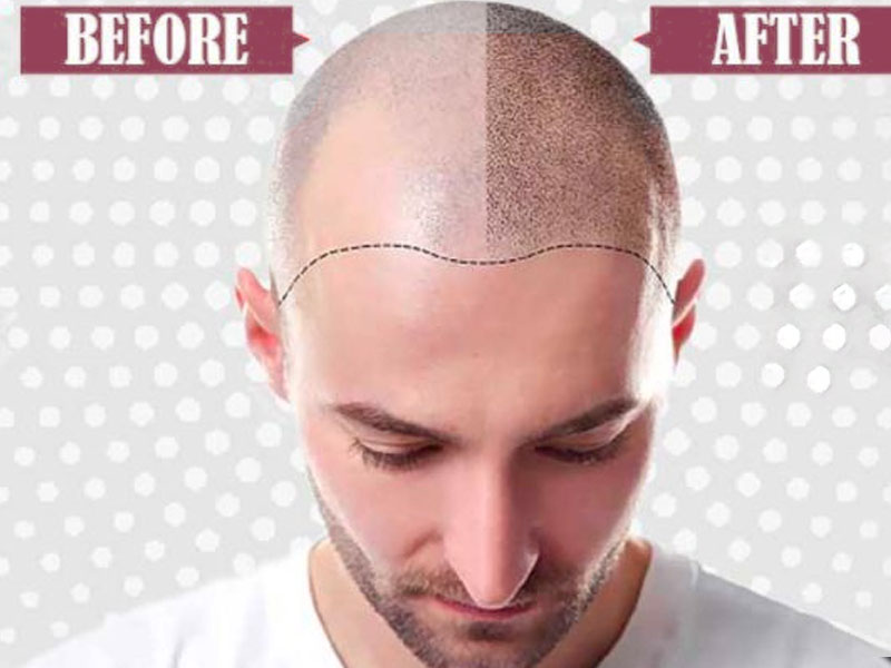 What is the most appropriate age for hair transplantation?​