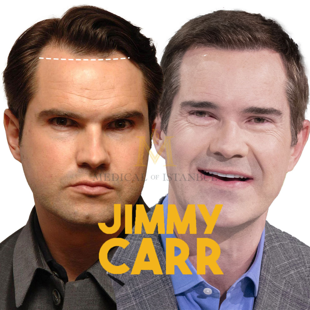 Jimmy Carr Hair Transplant: A Journey of Transformation