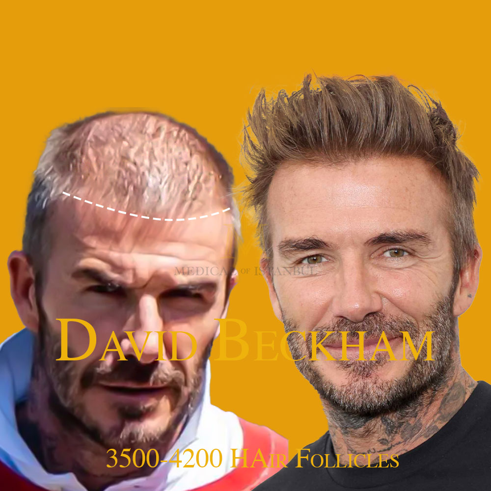 David Beckham Hair Transplant: A Journey of Transformation