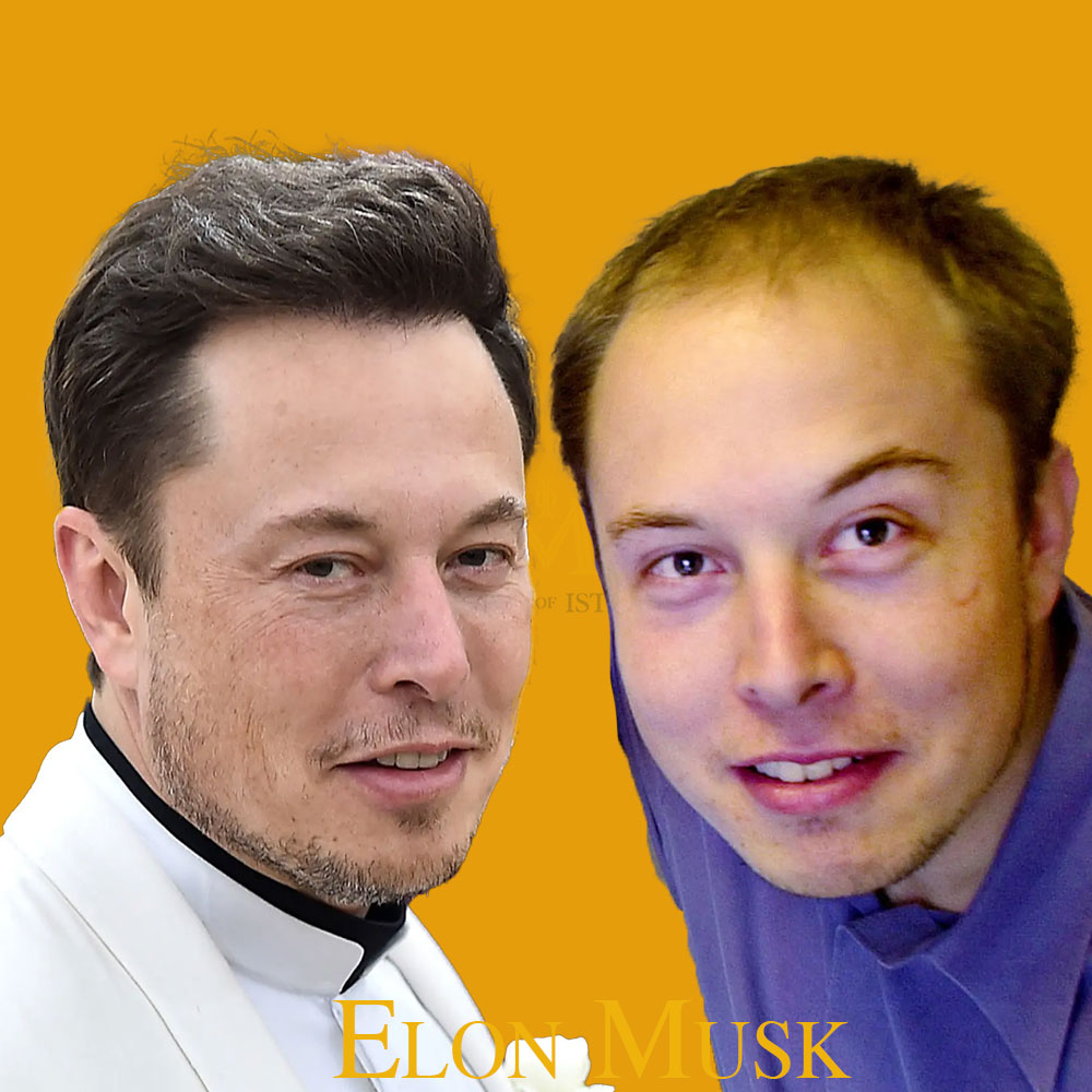 Elon Musk Hair Transplant: A Journey of Transformation 2024​
