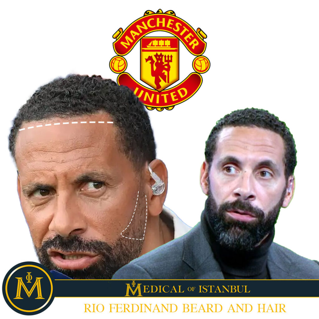 Rio Ferdinand's hair and beard transplant Remarkable Result.