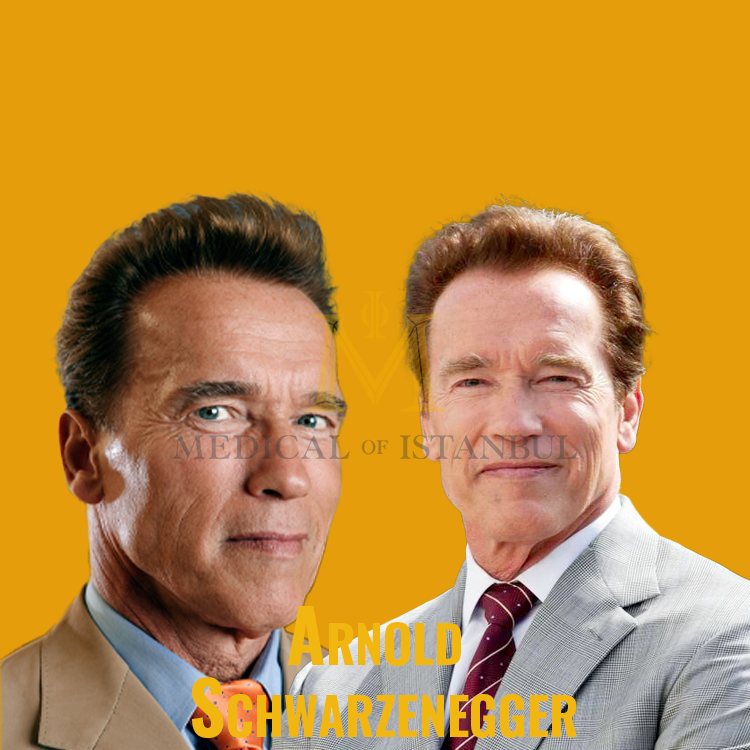 Arnold Schwarzenegger Hair Transplant A Journey of Transformation​