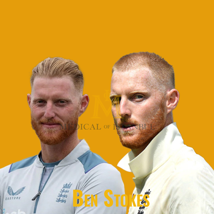 Ben Stokes Hair Transplant A Journey of Transformation​