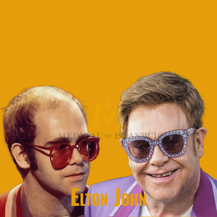 Elton John Hair Transplant A Journey of Transformation​