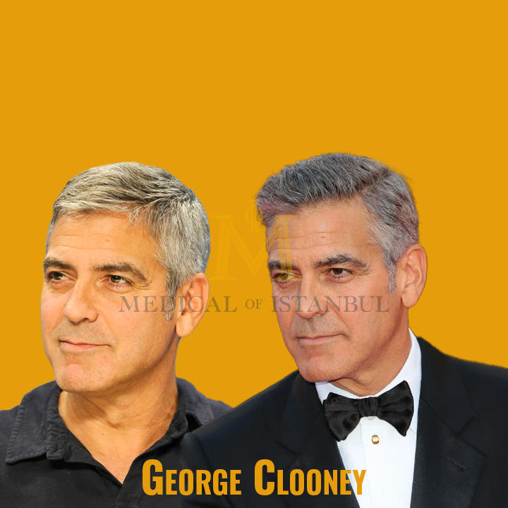 George Clooney Hair Transplant A Journey of Transformation​