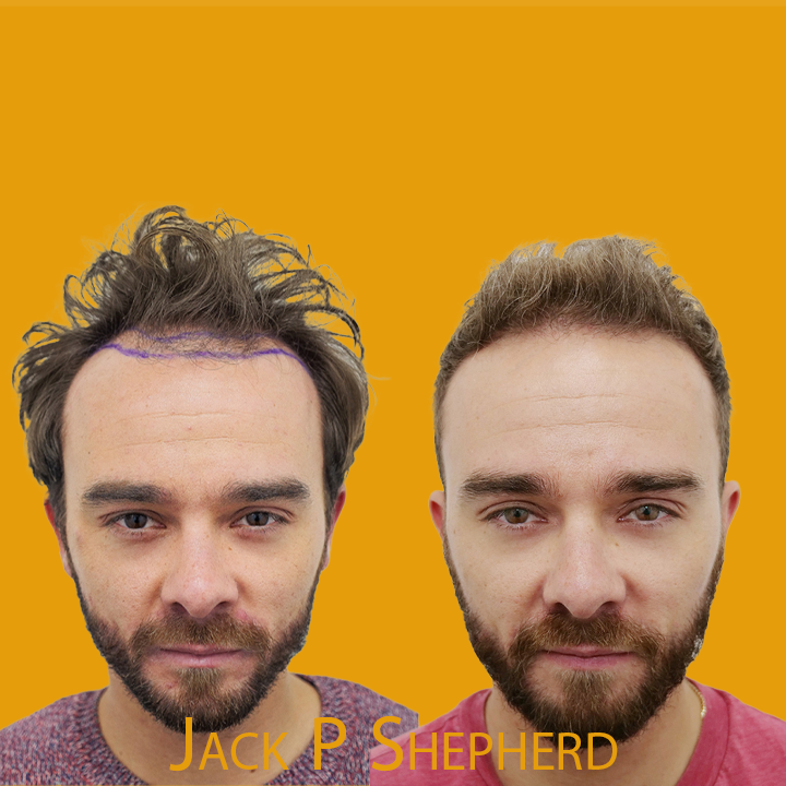 Jack P Shepherd Hair Transplant: A Journey of Transformation 2024