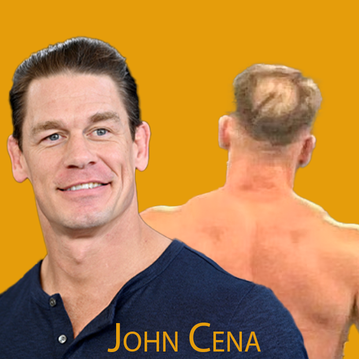 John Cena Hair Transplant: A Journey of Transformation 2024
