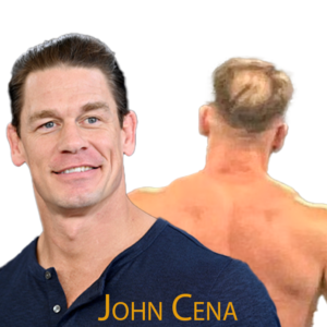 John Cena Hair Transplant: A Journey of Transformation 2024