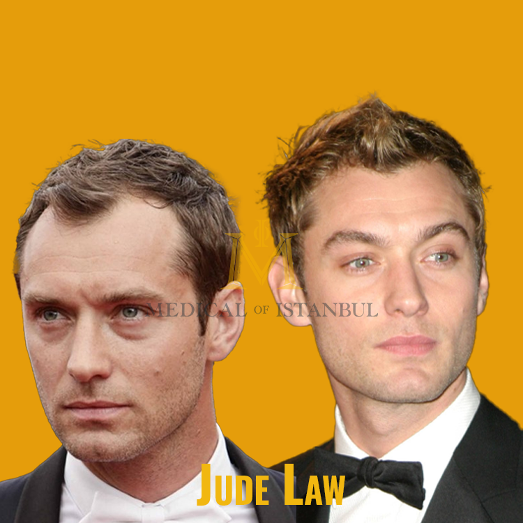 Jude Law Hair Transplant A Journey of Transformation​