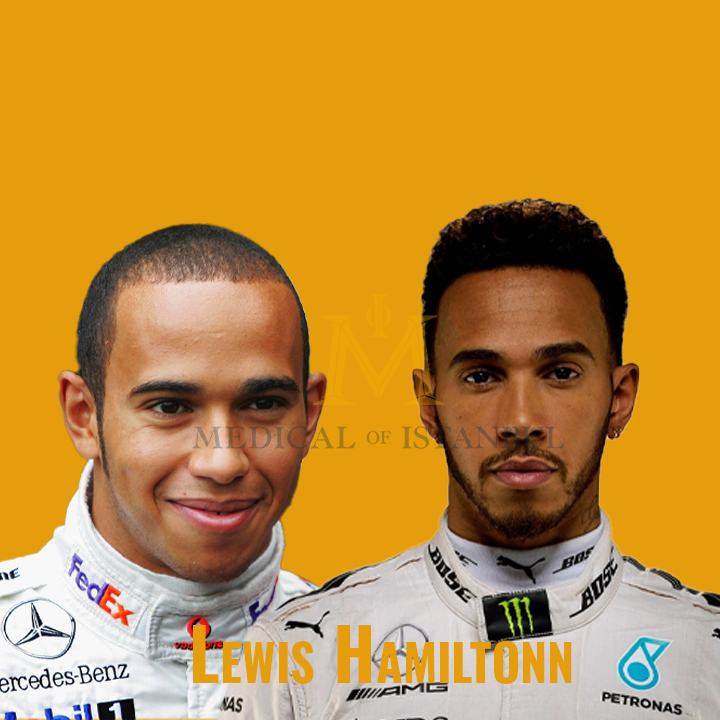 Lewis Hamilton Hair Transplant A Journey of Transformation​