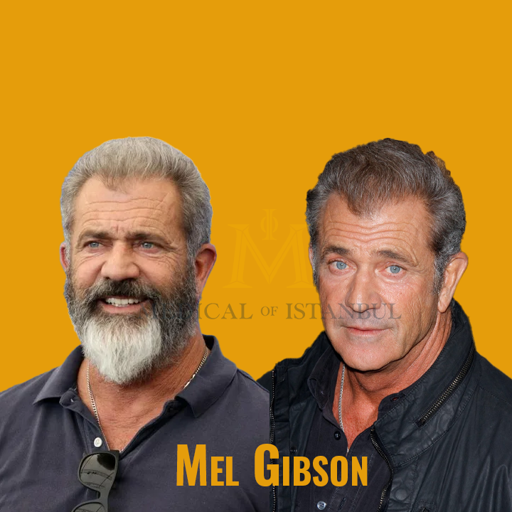 Mel Gibson Hair Transplant A Journey of Transformation​