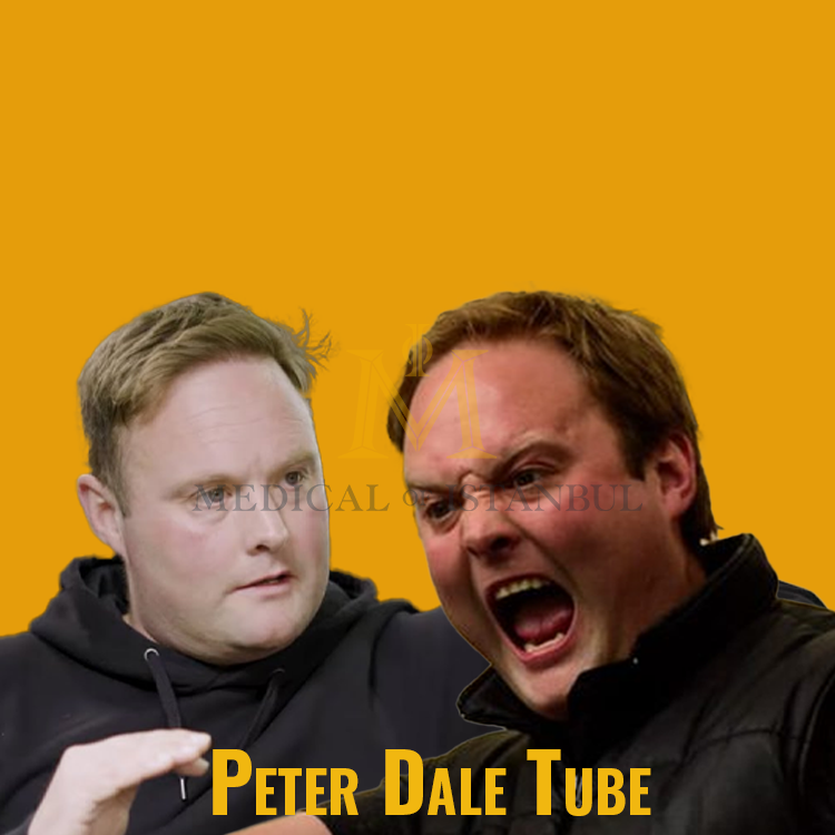 Peter Dale Tube Hair Transplant A Journey of Transformation​