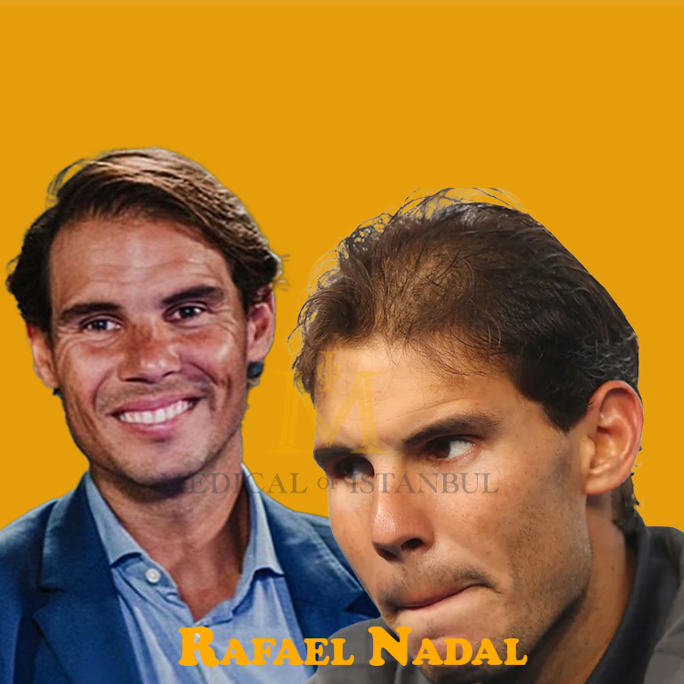 Rafael Nadal Hair Transplant: A Journey of Transformation 2024