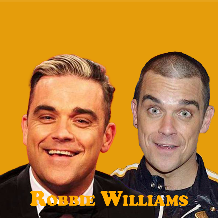 Robbie Williams Hair Transplant: A Journey of Transformation 2024