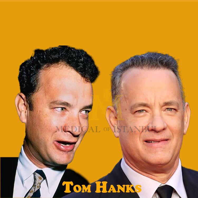 Tom Hanks Hair Transplant: A Journey of Transformation 2024