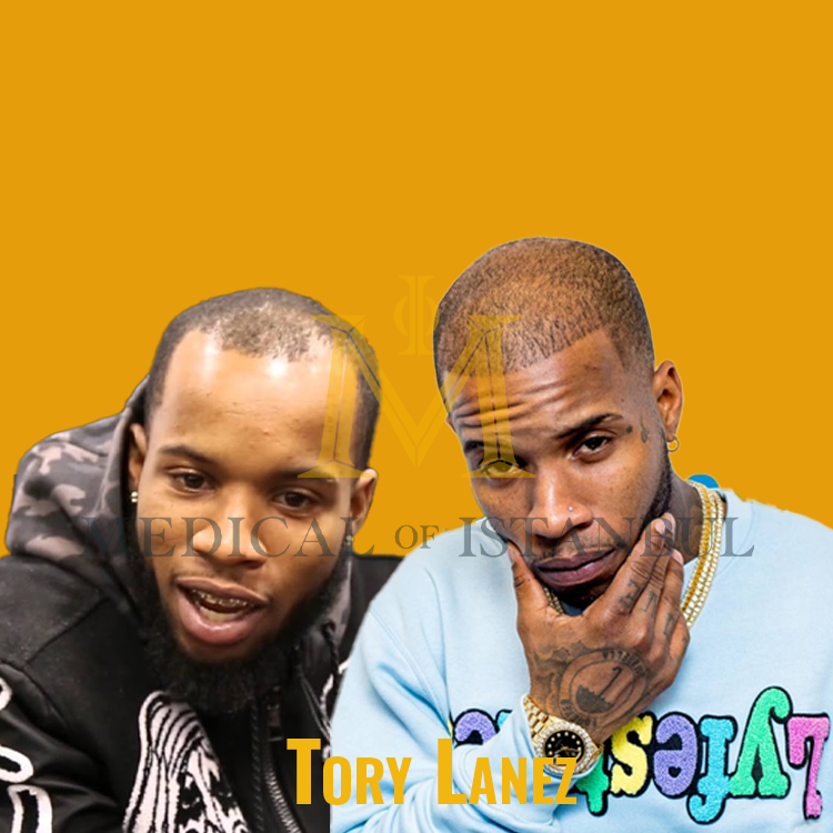 Tory Lanez Hair Transplant A Journey of Transformation​