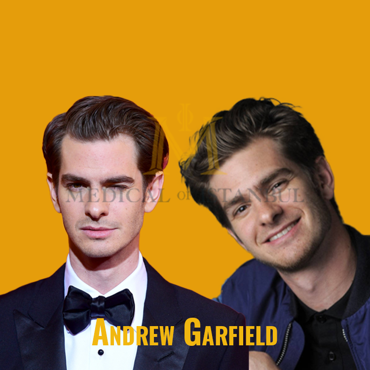 Andrew Garfield Hair Transplant A Journey of Transformation​