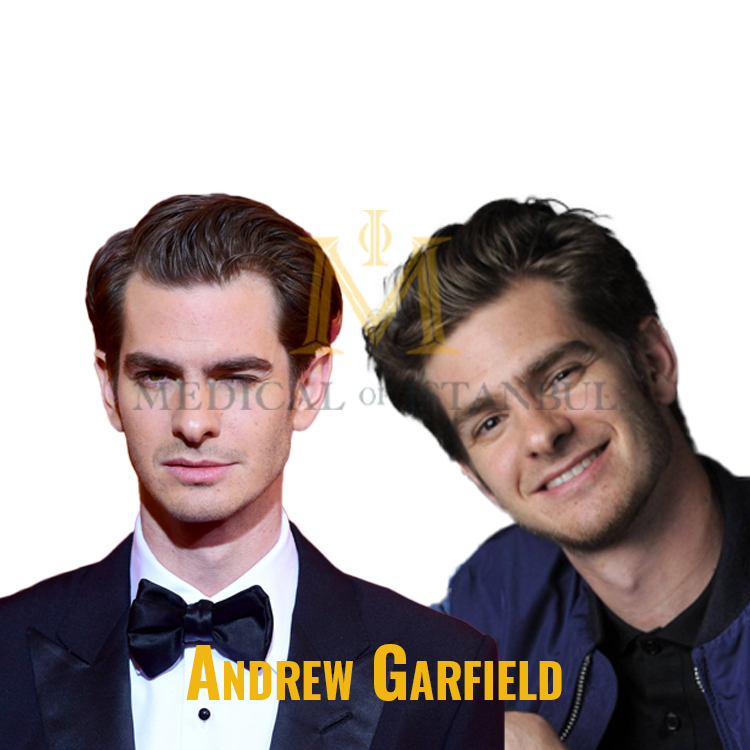 Andrew Garfield Hair Transplant A Journey of Transformation​