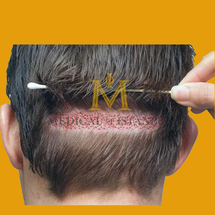 Do roots regrow in the donor area after hair transplantation?