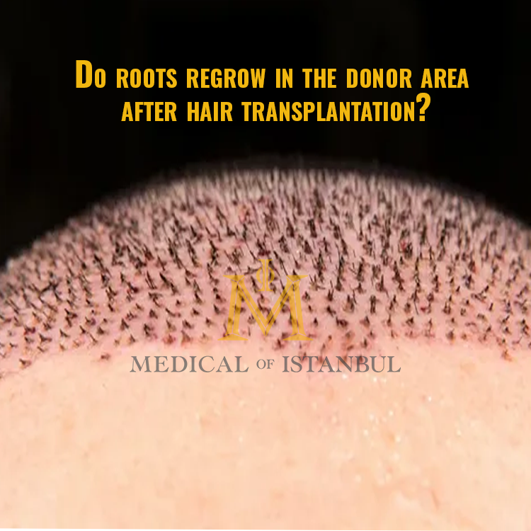 Do roots regrow in the donor area after hair transplantation?