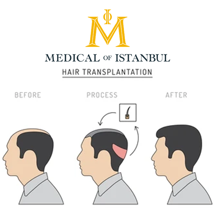 Which areas can be used as donors in hair transplantation