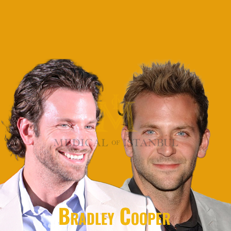 Bradley Cooper Hair Transplant A Journey of Transformation​
