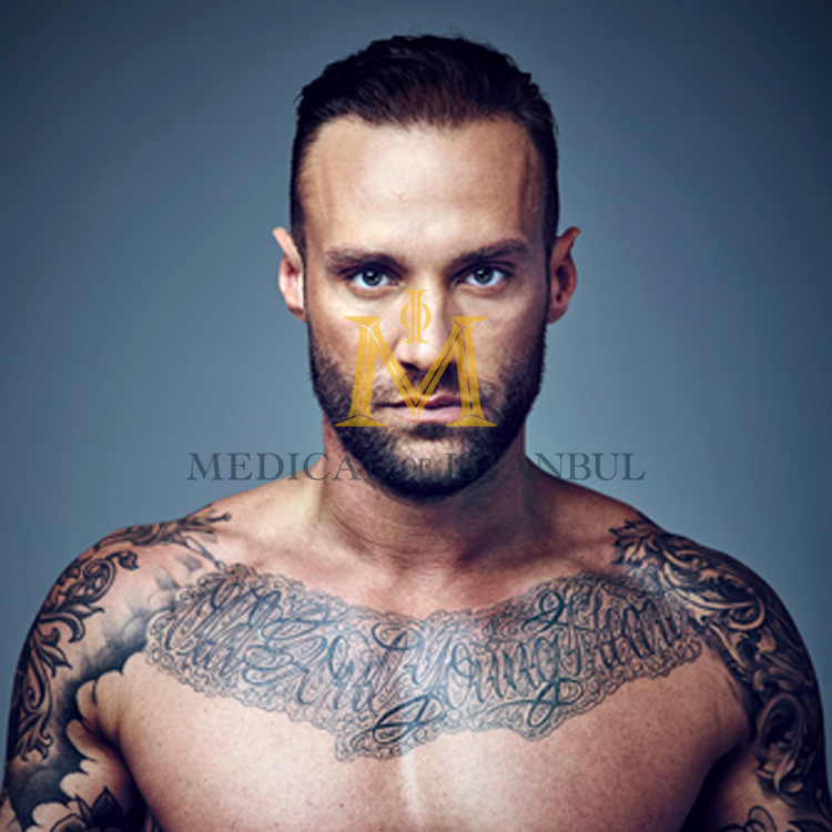 Calum Best Hair Transplant A Journey of Transformation​