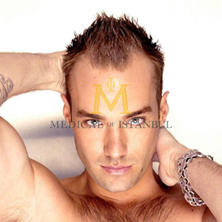 Calum Best Hair Transplant A Journey of Transformation 2024