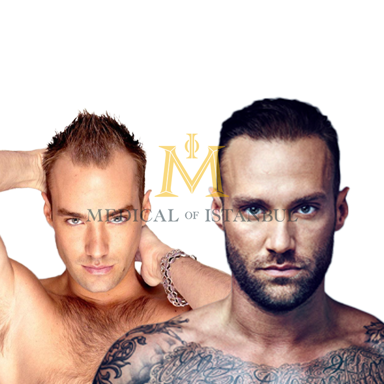 Calum Best Hair Transplant A Journey of Transformation​