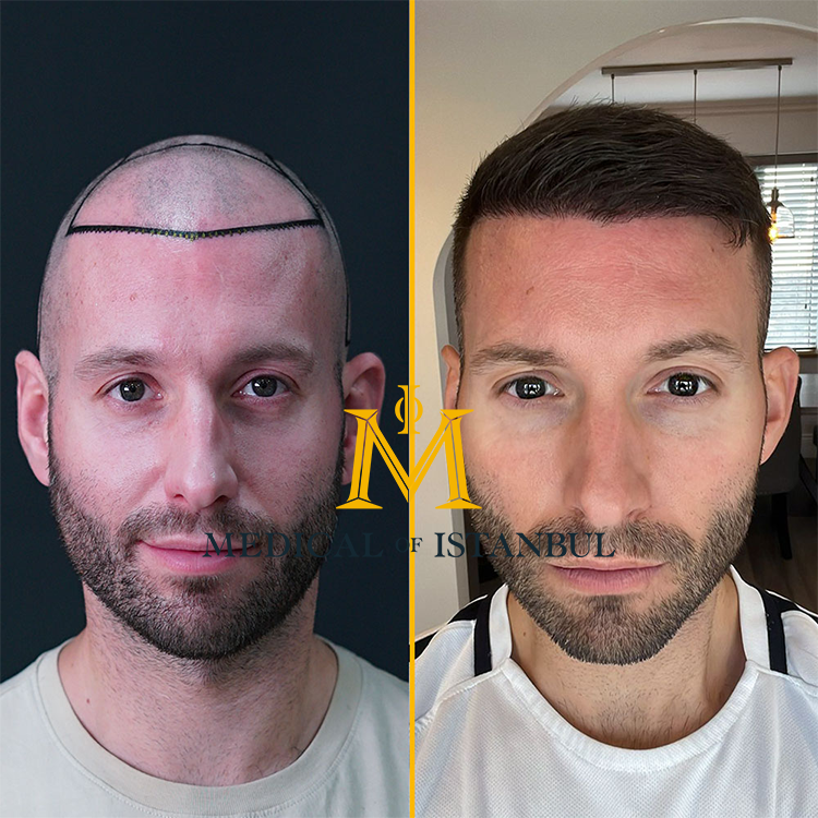 Before and After Hair Transplant