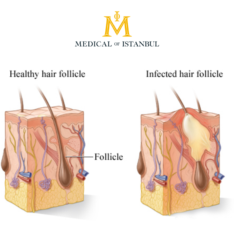 Folliculitis on Scalp After Hair Transplantation