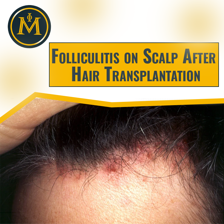 Folliculitis on Scalp After Hair Transplantation