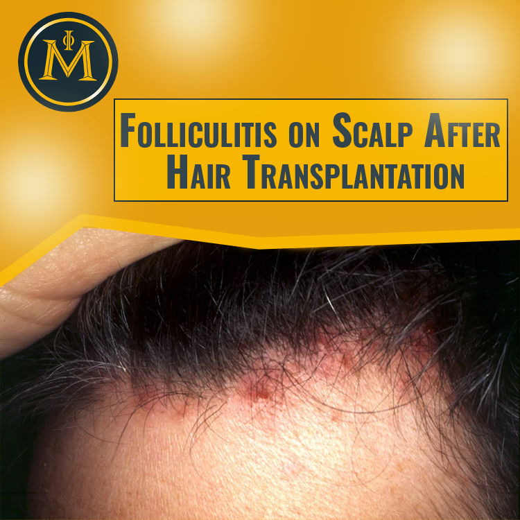 Folliculitis on Scalp After Hair Transplantation