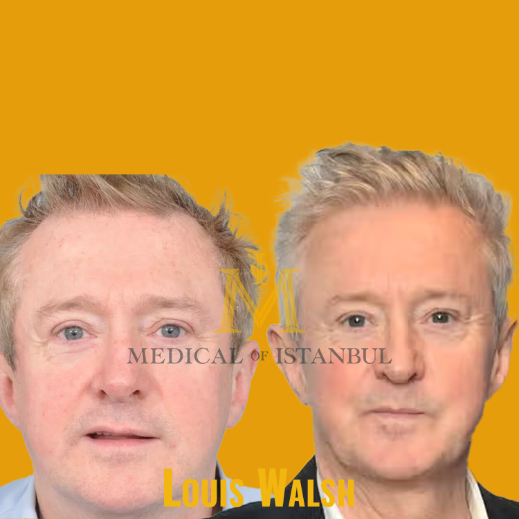Louis Walsh Hair Transplant A Journey of Transformation​