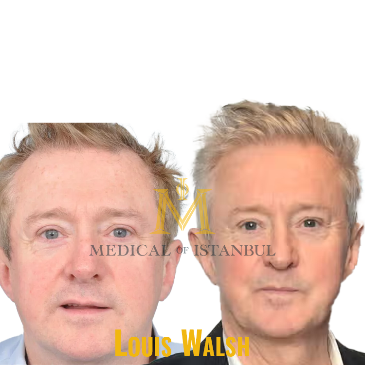 Louis Walsh Hair Transplant A Journey of Transformation​