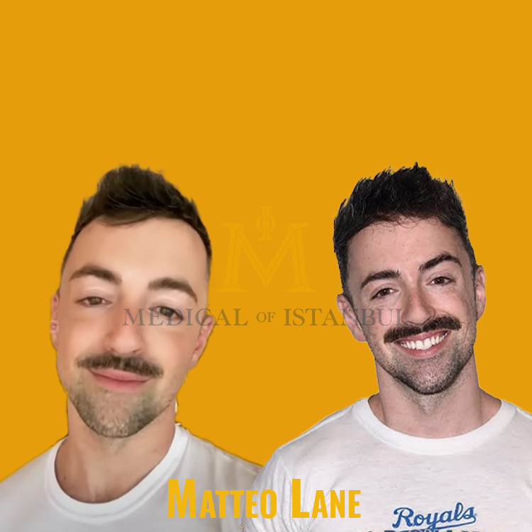 Matteo Lane Hair Transplant A Journey of Transformation​