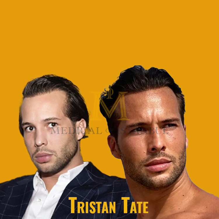 Tristan Tate Hair Transplant A Journey of Transformation​