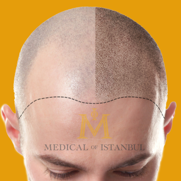 Which areas can be used as donors in hair transplantation