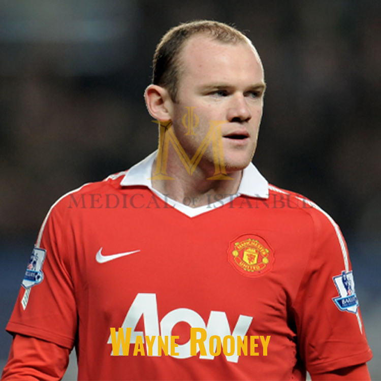 Wayne Rooney Hair Transplant A Journey of Transformation​