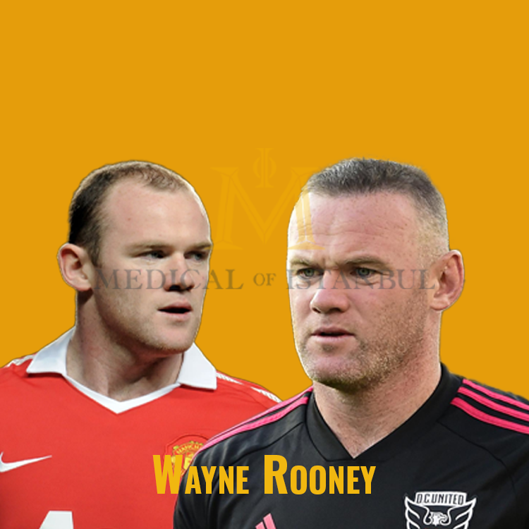 Wayne Rooney Hair Transplant A Journey of Transformation​
