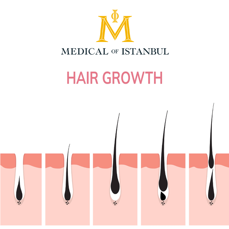 When is the Best Time to Get a Hair Transplant Treatment?