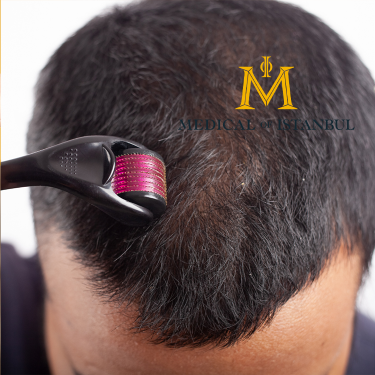 Microneedling For Hair Loss: Does it work for hair growth?