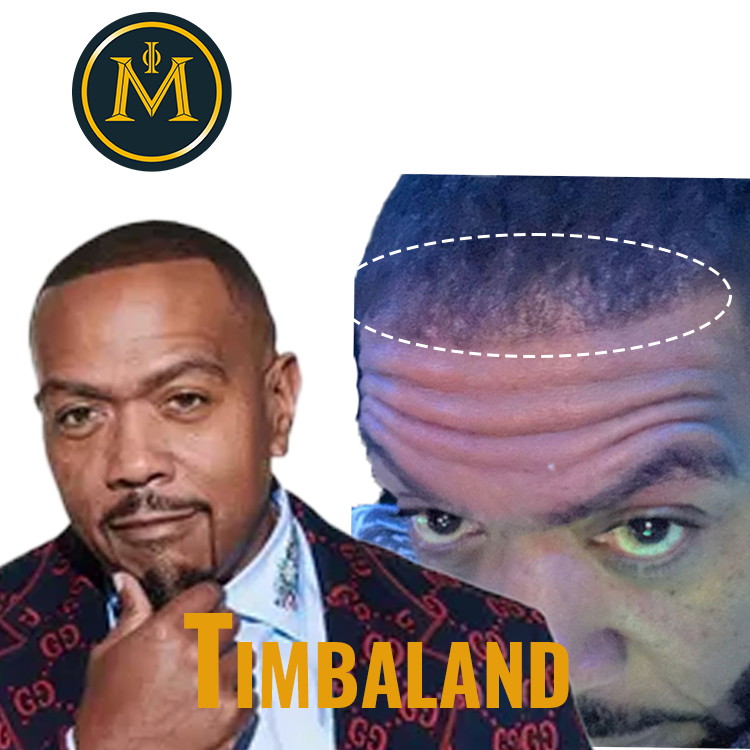 Timbaland Hair Transplant Journey