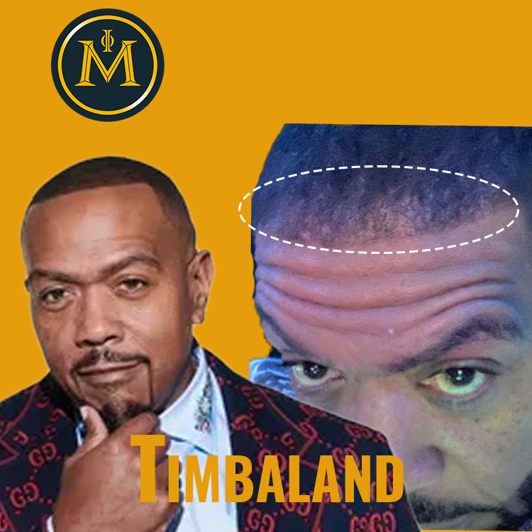 Timbaland Hair Transplant Journey