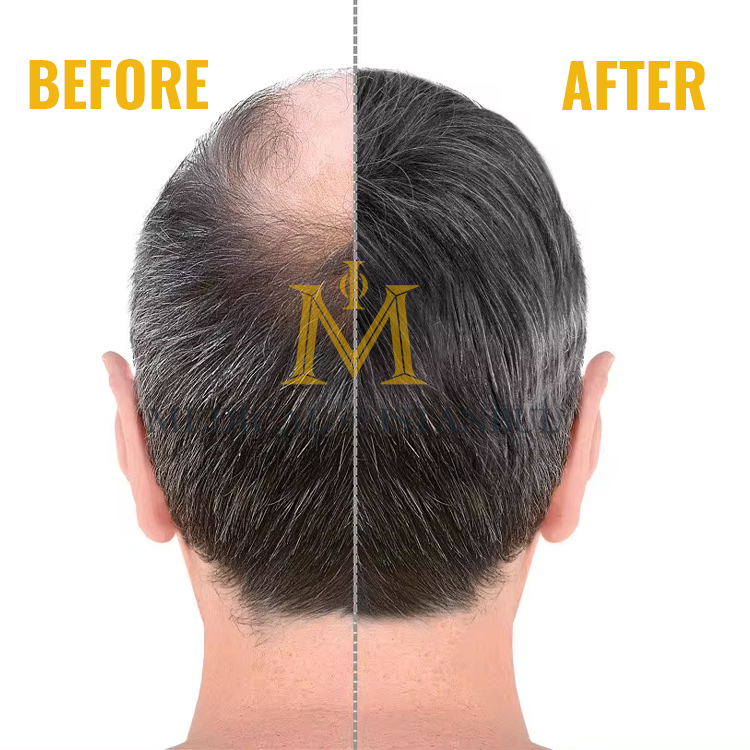 Understanding the Different Types of Hair Transplants