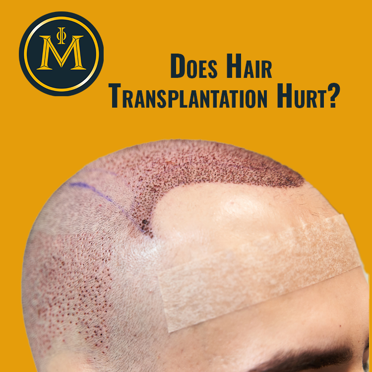 Does Hair Transplantation Hurt?