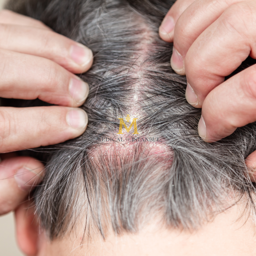 What is Keloid Disease and How Does It Affect Hair Transplant Candidacy?