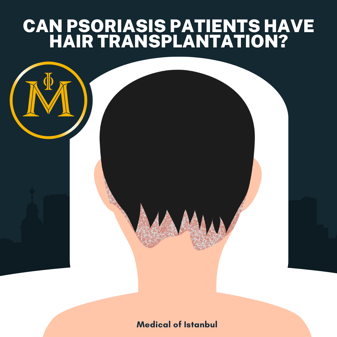 Can psoriasis patients have hair transplantation?