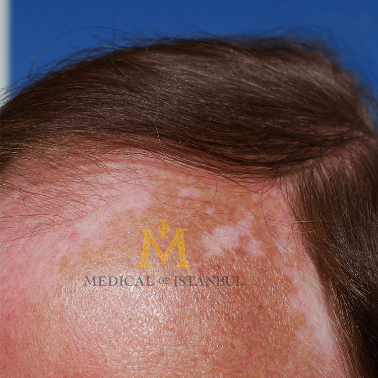 Hair Transplant and Sun Exposure